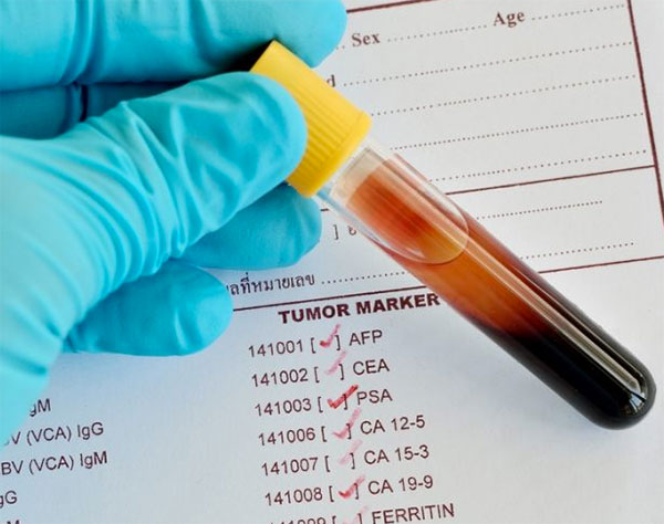 Онкомаркеры – сдавать или нет? 