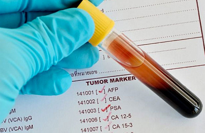 Онкомаркеры – сдавать или нет? 